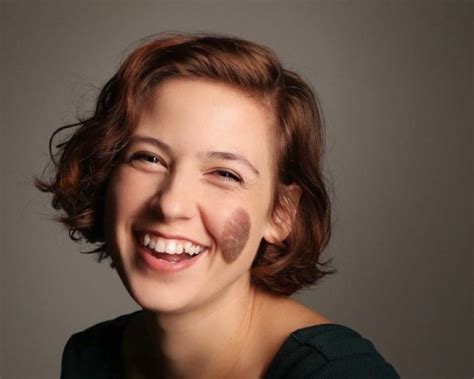 Chloe Radcliffe’s Birthmark: Embracing Imperfections and Comedy